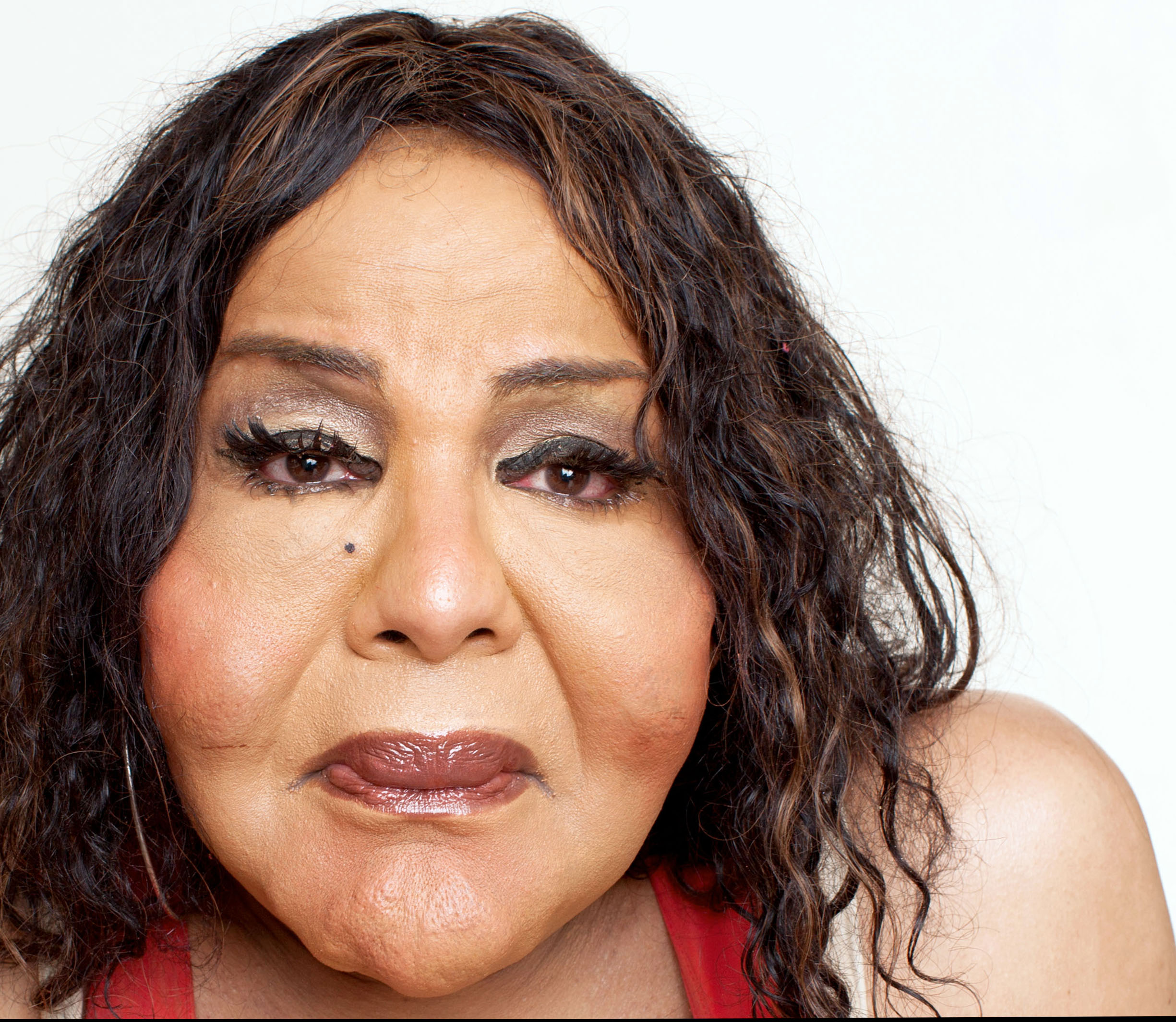 "Cement Face", victim of botched botox, fl.