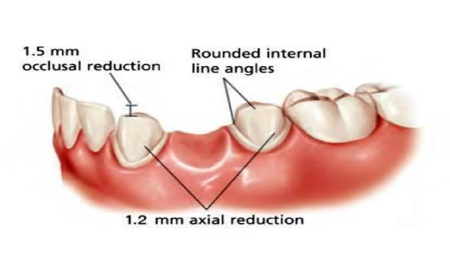 Posterior Bridge Preparation