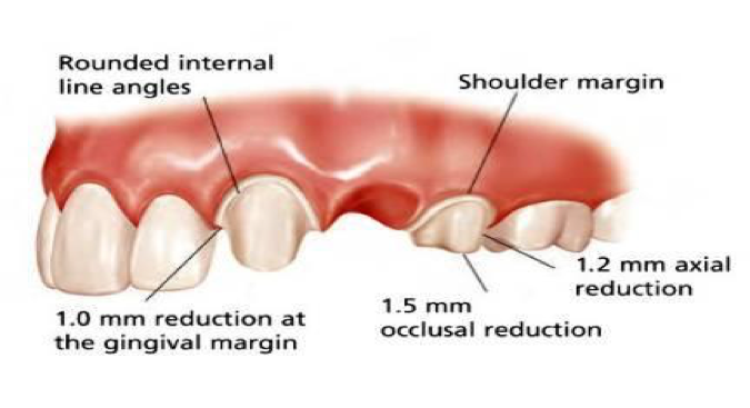 Posterior Bridge Preparation