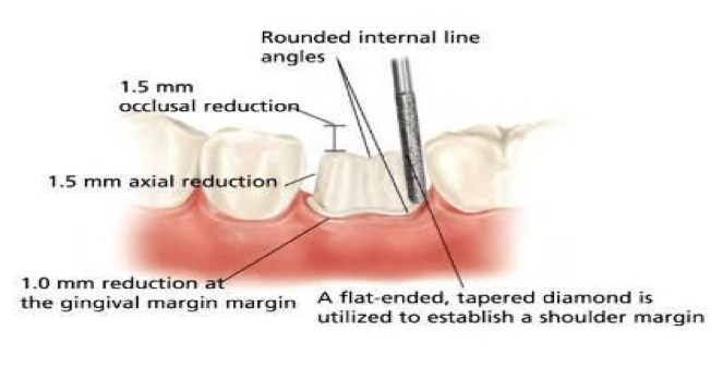 Posterior Crown