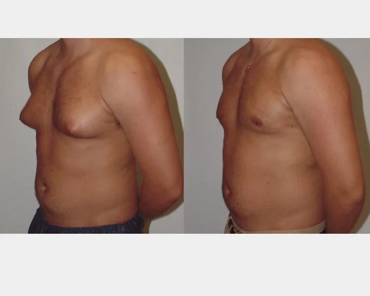 After 8 Lipo Body Shaping System Treatments and 8 Cellulite Massage System Treatments.