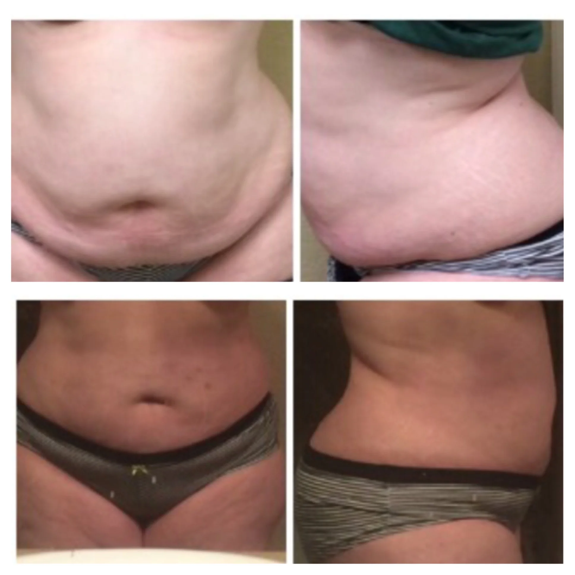 Fast Results That Last! Real Client Pictures! After 4 Treatments Twice a week for 2 weeks. 
