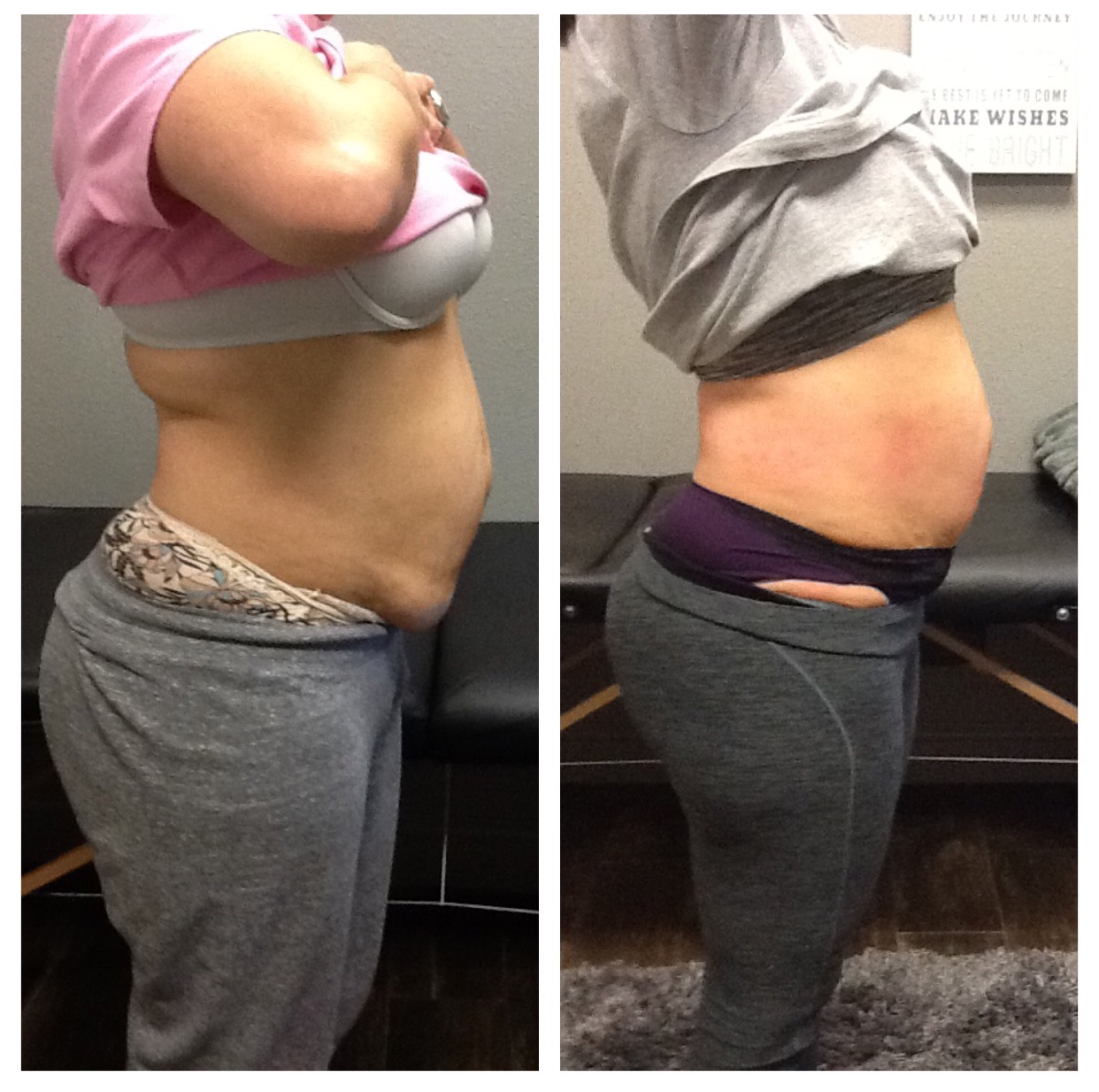After 6 Lipo Body Shaping System Treatments and 6 Cellulite Massage Treatments - Results after 2 days a week for 3 weeks.