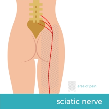 Sciatic Nerve Pain Treatments in Atlanta