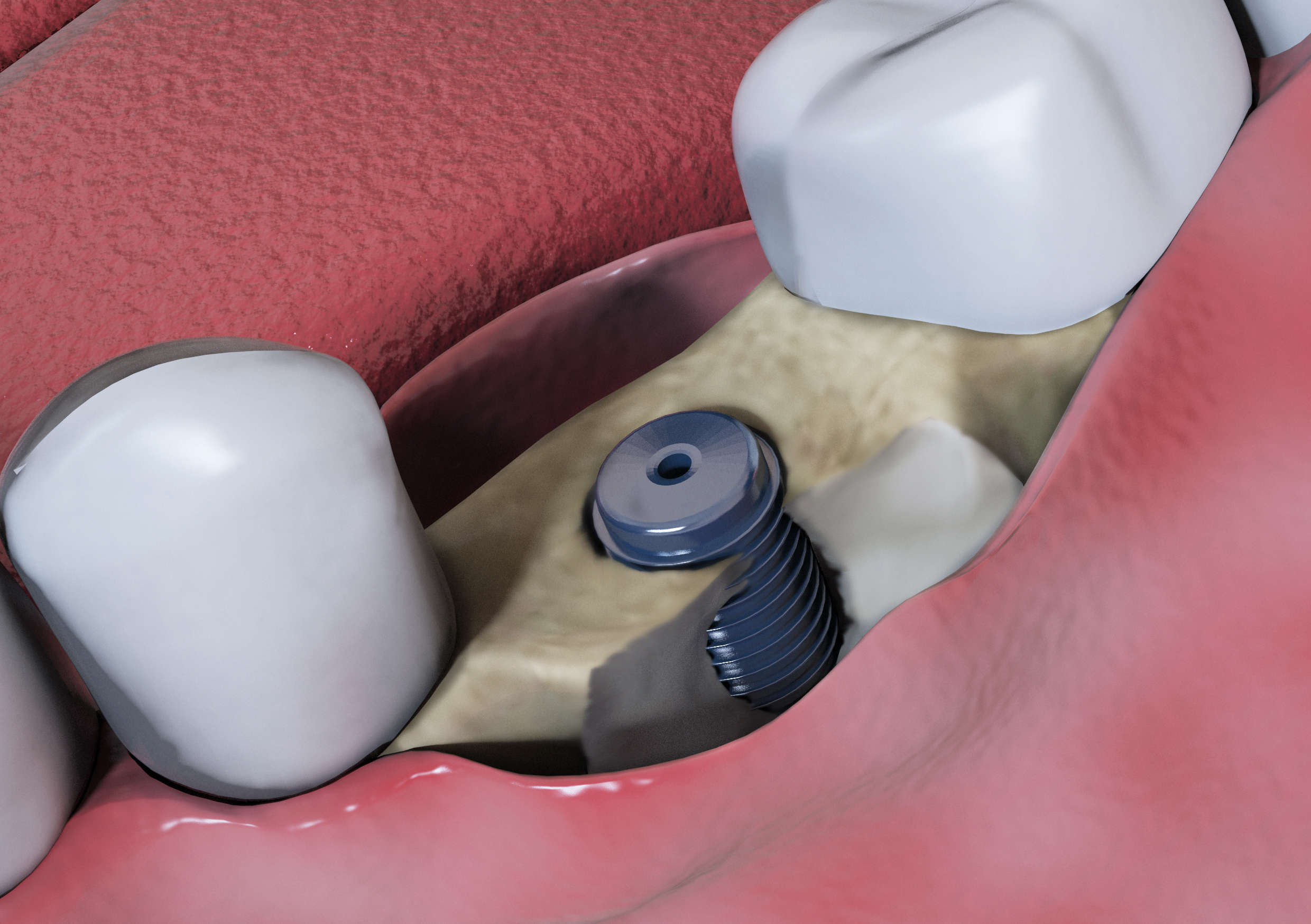 1. Bone Loss Insufficient bone volume to anchor implant.
