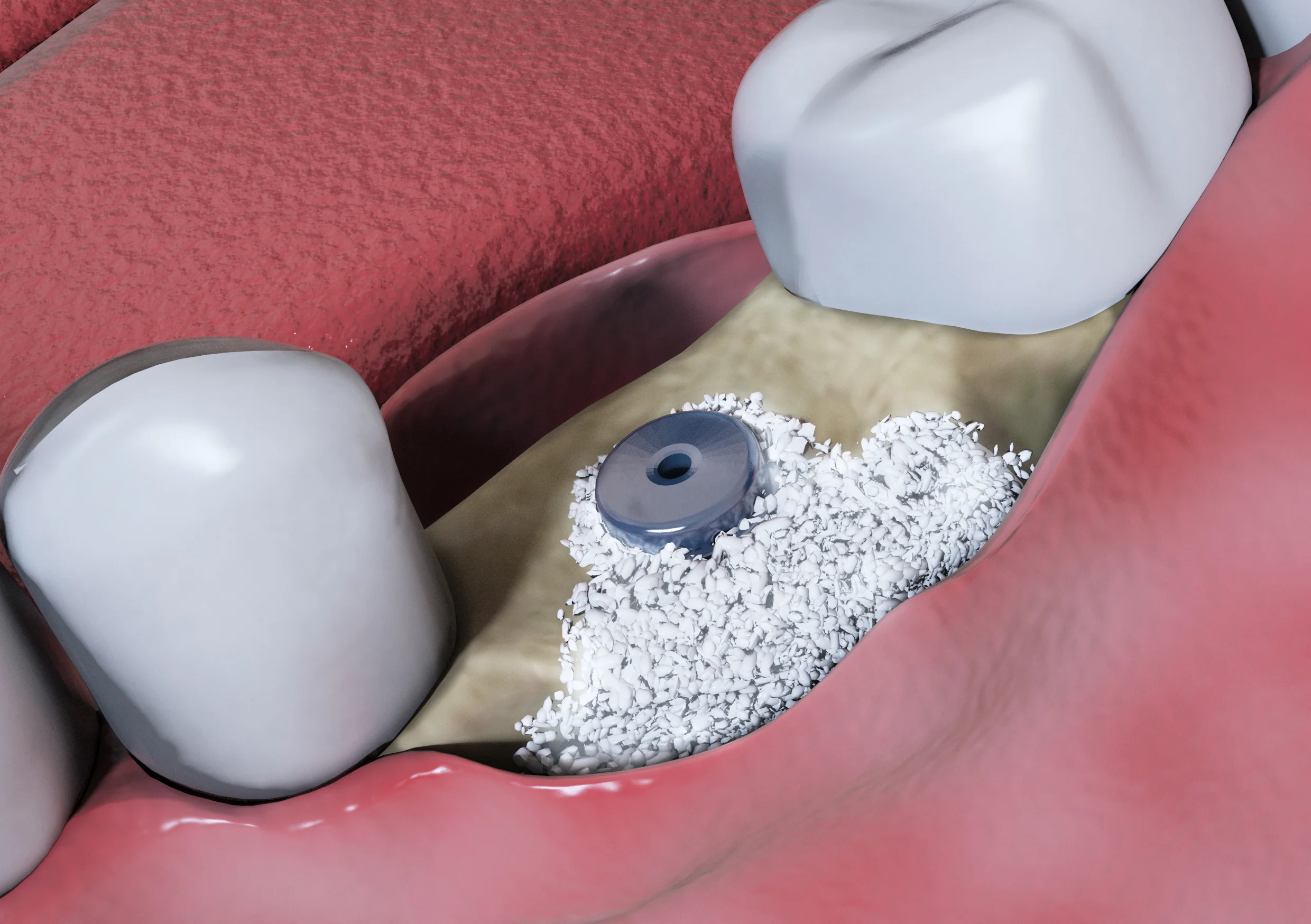 2. Bone Graft Fill bone defect site with bone grafting material.