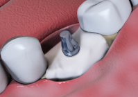 2. CelGro™ placed over defect and implant abutment installed