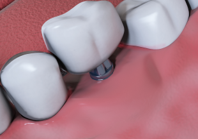 4. Crown placement 3-6 months later