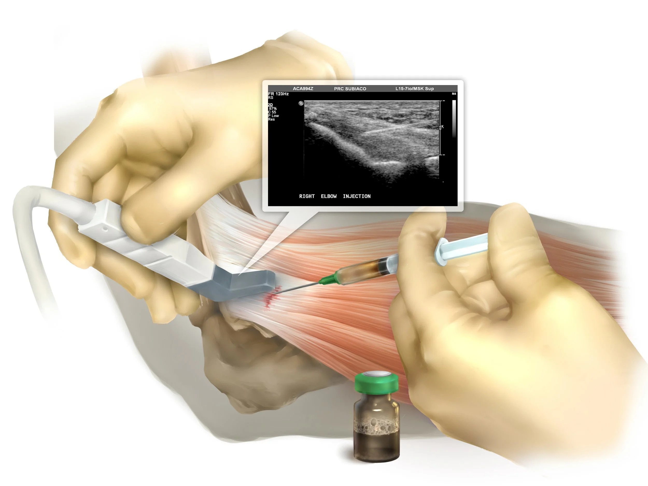 Tendon Injections : Injections with Ultrasound Guidance – RFPEA