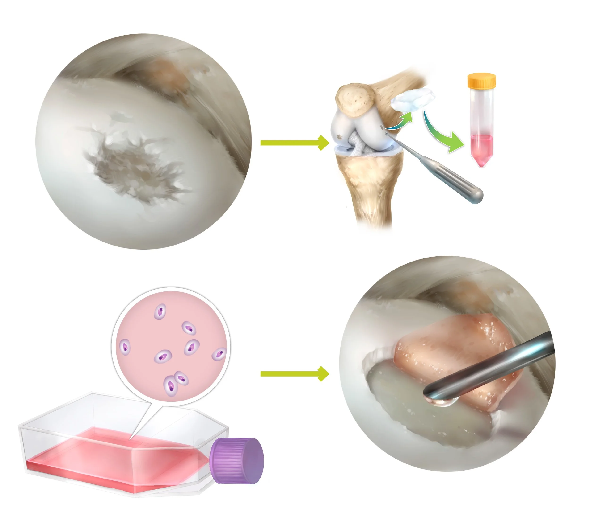 Top left: Cartilage defect Top right: Health cartilage biopsied and sent to Orthocell laboratory Bottom left: Cells grown under sterile controlled conditions for 5 weeks Bottom right: Cells and scaffold implanted back into repair site to regenerate damaged cartilage.