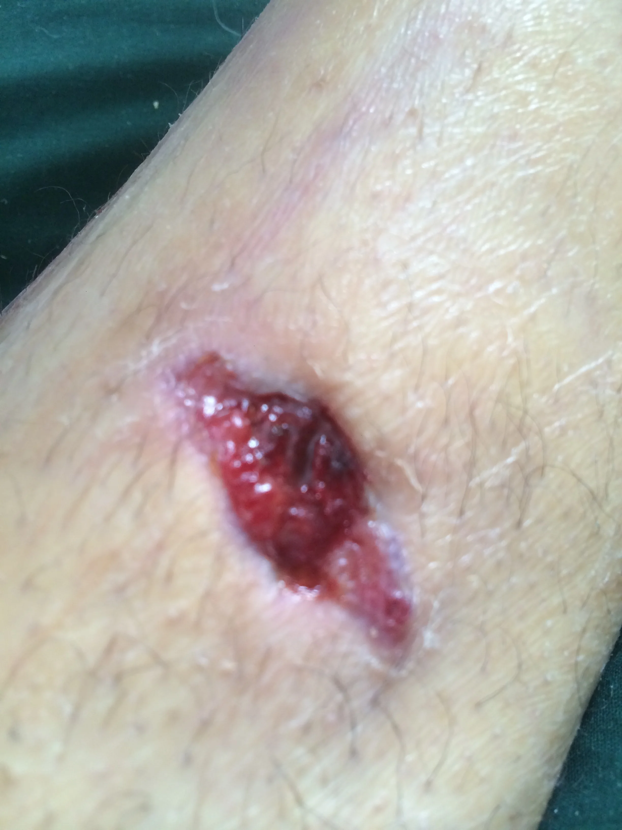 Puncture hole where the bone came out of the skin.