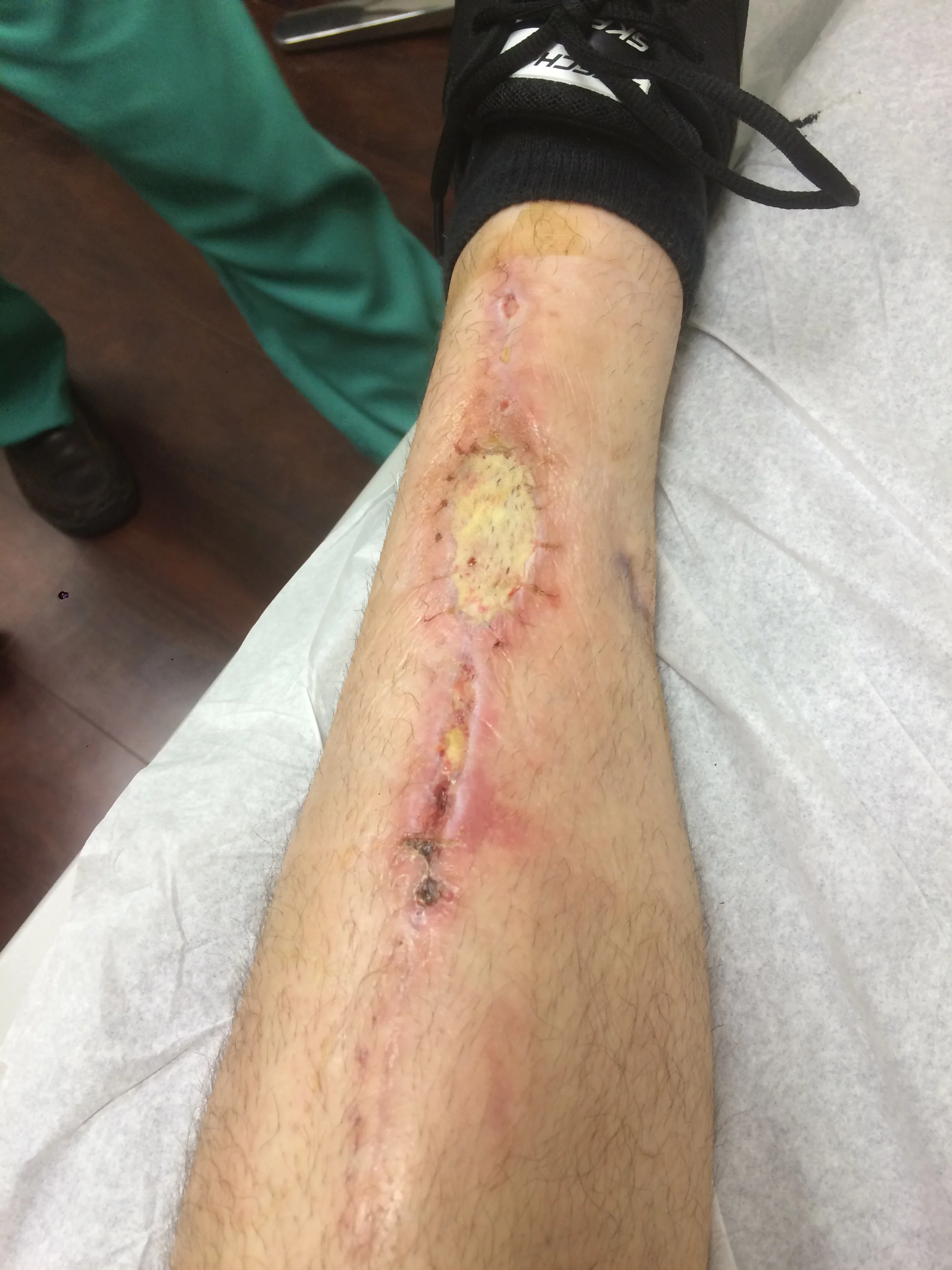 Incision site after skin graft.