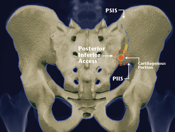 Posterior Inferior Access