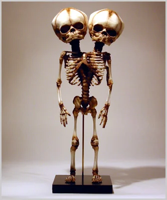 Two-Headed Baby Skeleton