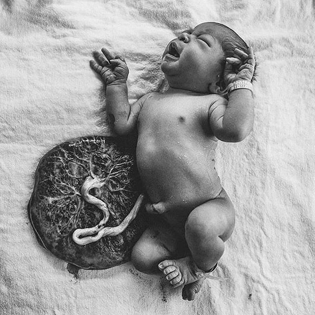 Love this overview of the placenta by @mamaglow .
We did placenta encapsulation and I’m a big advocate of it helping postpartum mood disorders for all the reasons stated below. Mainly hormones!
.
As with everything you have to see what works for your body. Many moms that I know who did placenta encapsulation took a lower recommendation of the pills over a longer duration. That’s what I did and that’s what felt right for my body.
.
I feel pretty strongly that it was my saving grace for the long road of postpartum:)
.
Did you try it? Are you curious about it?
.
.
. "
Mama Glow - PLACENTA- “Circular Cake’ Latin, an organ that develops in your uterus during pregnancy providing oxygen & nutrients to your growing baby. It removes waste products from your baby's blood. The placenta attaches to the wall of your uterus, & your baby's umbilical cord arises from it. It’s a barrier between fetal & maternal circulations. ⠀
_
The placenta is considered the “external soul” in Old Testament. Produces hormones - (hCG), progesterone, estrogen, & human placental lactogen (hPL) In Bali the placenta is called the “Ari Ari” deriving from the word, younger sibling, & is the physical body of the baby’s guardian angel. Lotus birth ritual- leaving the umbilical cord uncut after childbirth so that the baby is left attached to the placenta until the cord naturally separates at the umbilicus, usually 3-10 days. ⠀
_⠀
Placental encapsulation is ritual of preparing the placenta through steaming, sometimes with Chinese herbs, dehydrating, grinding, & making pills. Taken by the mother during the postpartum period. ⠀
_⠀
Benefits include: * Increased release of the hormone oxytocin, which helps the uterus return to normal size & encourages bonding with the infant⠀
* Increase in CRH, stress-reducing hormone⠀
* Decrease in post-partum depression * Restoration of iron levels in the blood⠀
* Increase in milk production⠀
_⠀
Prepare for your placenta encapsulation- ⠀
Pack bag & bring a small portable cooler to place of birth. Contact or have your doula contact your placenta encapsulist within 6 hours postpartum & schedule a pick up time for your placenta. _⠀
📷 @elliana_allon 🌟 #mamaglow"⠀