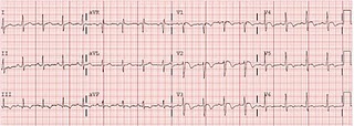 PE with anterior and inferior T inversion.jpg
