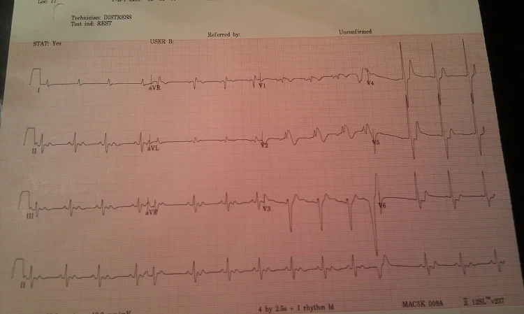 amiodarone, more calcium and bicarb - Copy.jpg