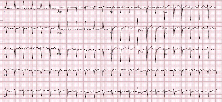atrial tach retrograde p.jpg