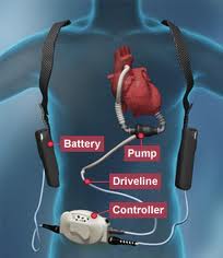 LVAD image.jpg
