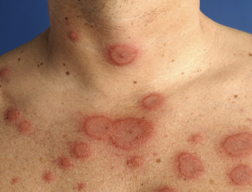 how to treat rash from bactrim