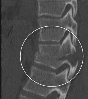 Chance Fracture