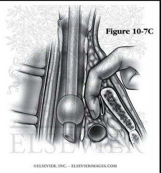 Use hyperinflation of trach tube balloon initially to compress the innominate artery. If that is ineffective, use your finger to hold pressure. Third maneuver is apply traction to the tracheostomy tube to compress the vessel.