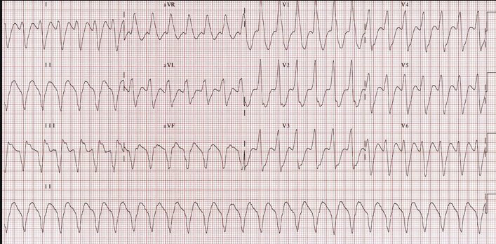 V-tach. Harwood comment you know this is V-tach based on NorthWest axis (down in I and AVF) and QRS >140 ms. 