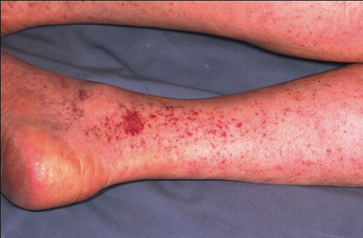 The rash of Rocky Mountain Spotted Fever starts on the ankles and wrists and moves toward the trunk. Fever precedes the rash by a few days.