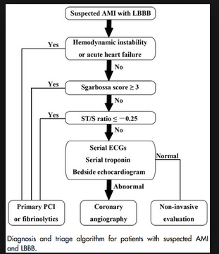 Decision rule using Sgarbossa criteria and ST/S ratio to diagnose AMI in the setting of LBBB
