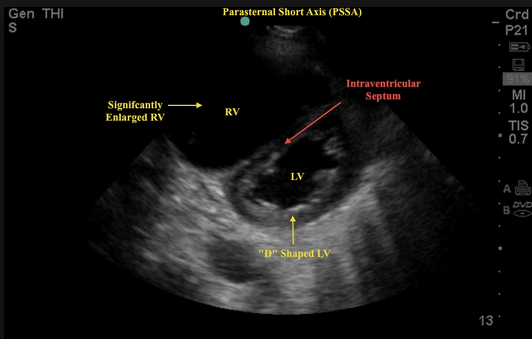 D-sign showing PE. Elevated pressure in the RV flattens the LV septal wall making the LV look like the letter D on a parasternal short view.