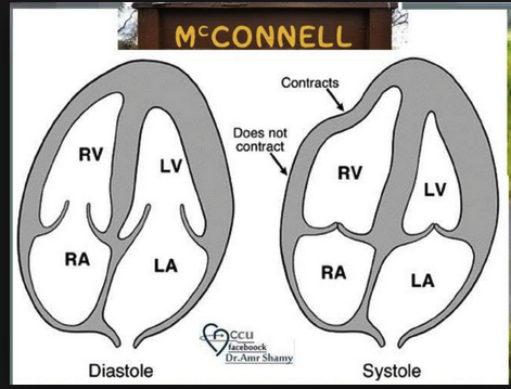 McConnell sign. The apex of the RV contracts OK despite overall RV hypokinesis. This is a specific sign of PE.