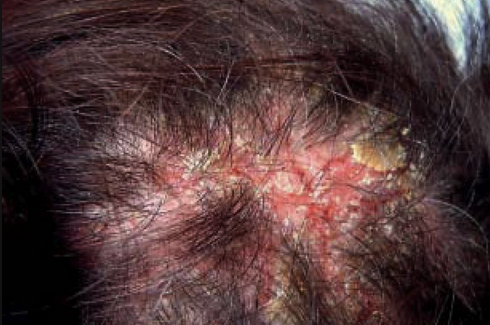 Kerion, treat with griseofulvin or fluconazole. Kerion causes hair loss which can help differentiate it from other scalp lesions.