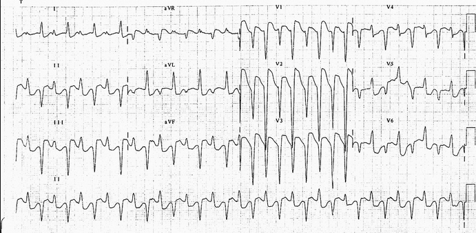 Bidirectional ventricular tachycardia which is highly specific for digoxin toxicity