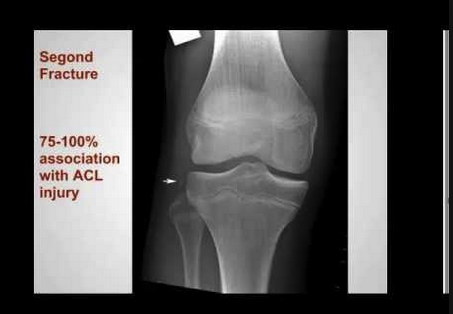 Segond Fracture