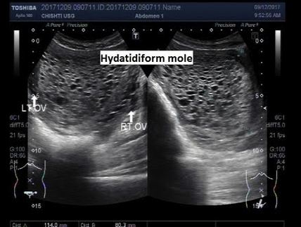 Patients with molar pregnancy may have larger uterus and may have very high beta-hcg.
