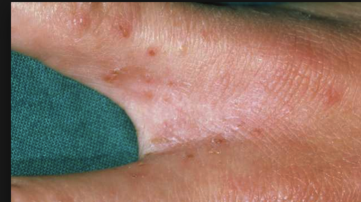 Rash c/w scabies