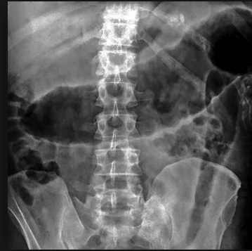 Toxic megacolon can be seen with either ulcerative colitis or crohn’s disease. Bowel is >6cm in diameter. There is loss of haustra.