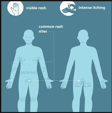 Typical locations of scabies rash