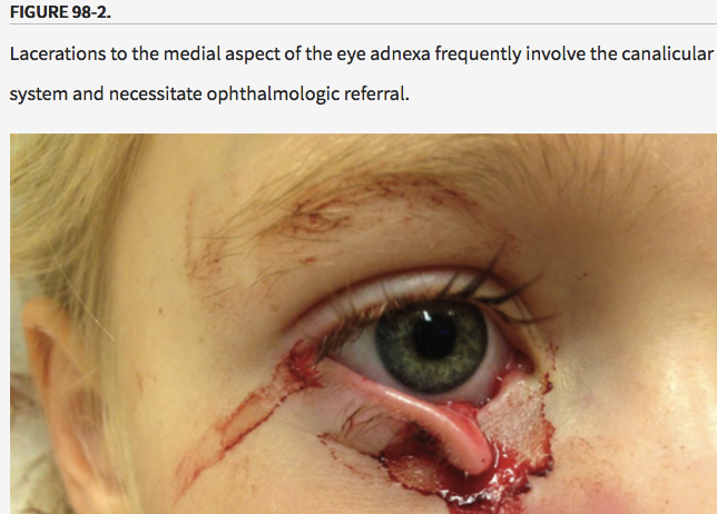 Don’t try to close lacerations near the medial canthus on either the upper or lower eyelids. There can be an injury to the tear duct. Consult Ophthalmology.