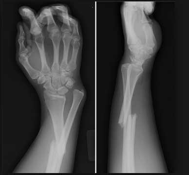 Galeazzi Fracture, fracture of the distal radius with radial-ulnar dislocation. This injury requires surgical management.