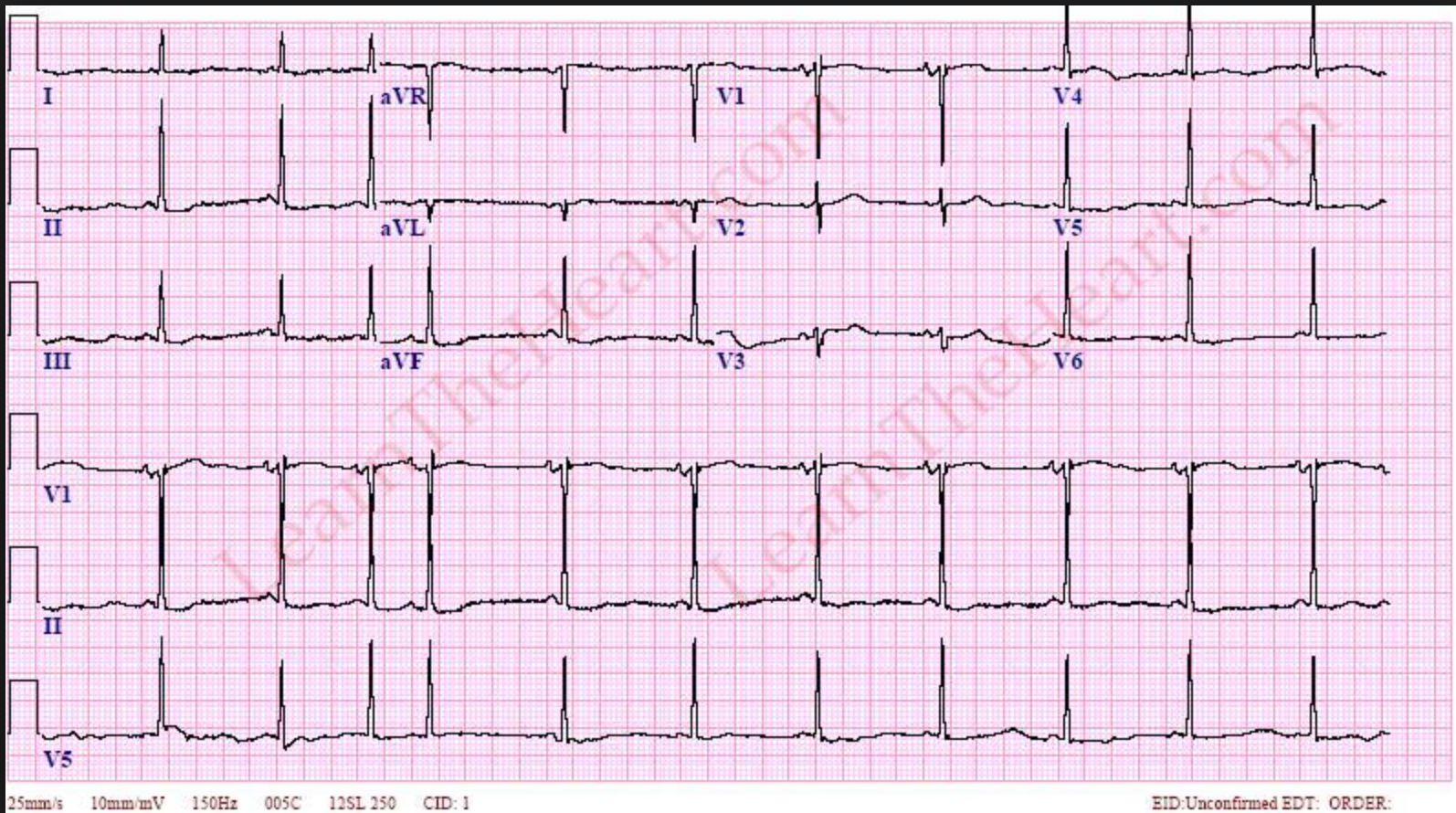 Синдром лауна. Синдром лгл на экг. Синдром лауна. Синдром предвозбуждения желудочков на экг. Синдром спящий красавицы.