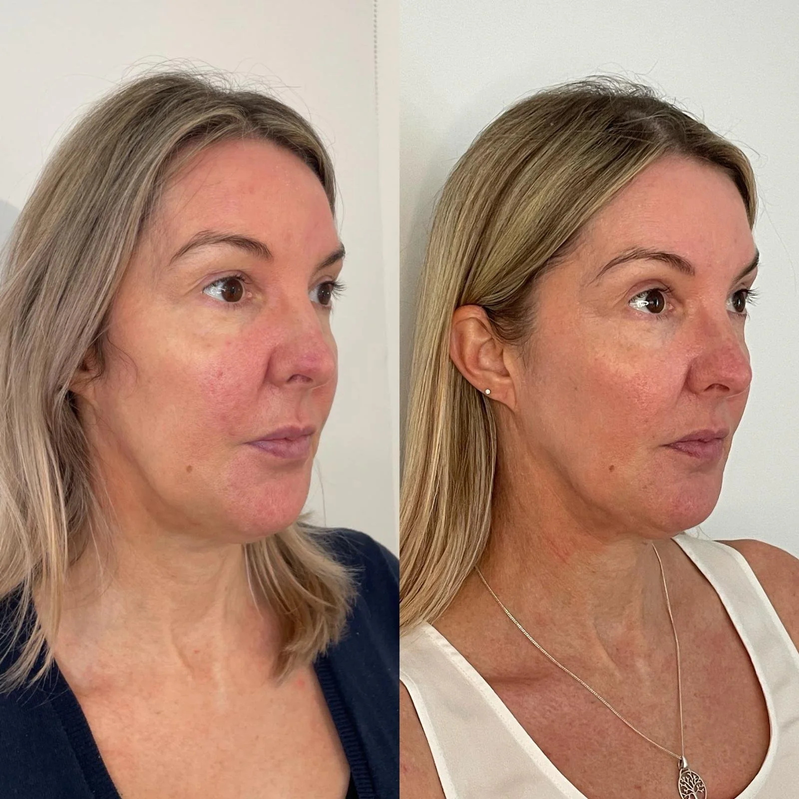 dermalux before and after