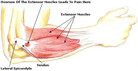 elbow pain.jpg