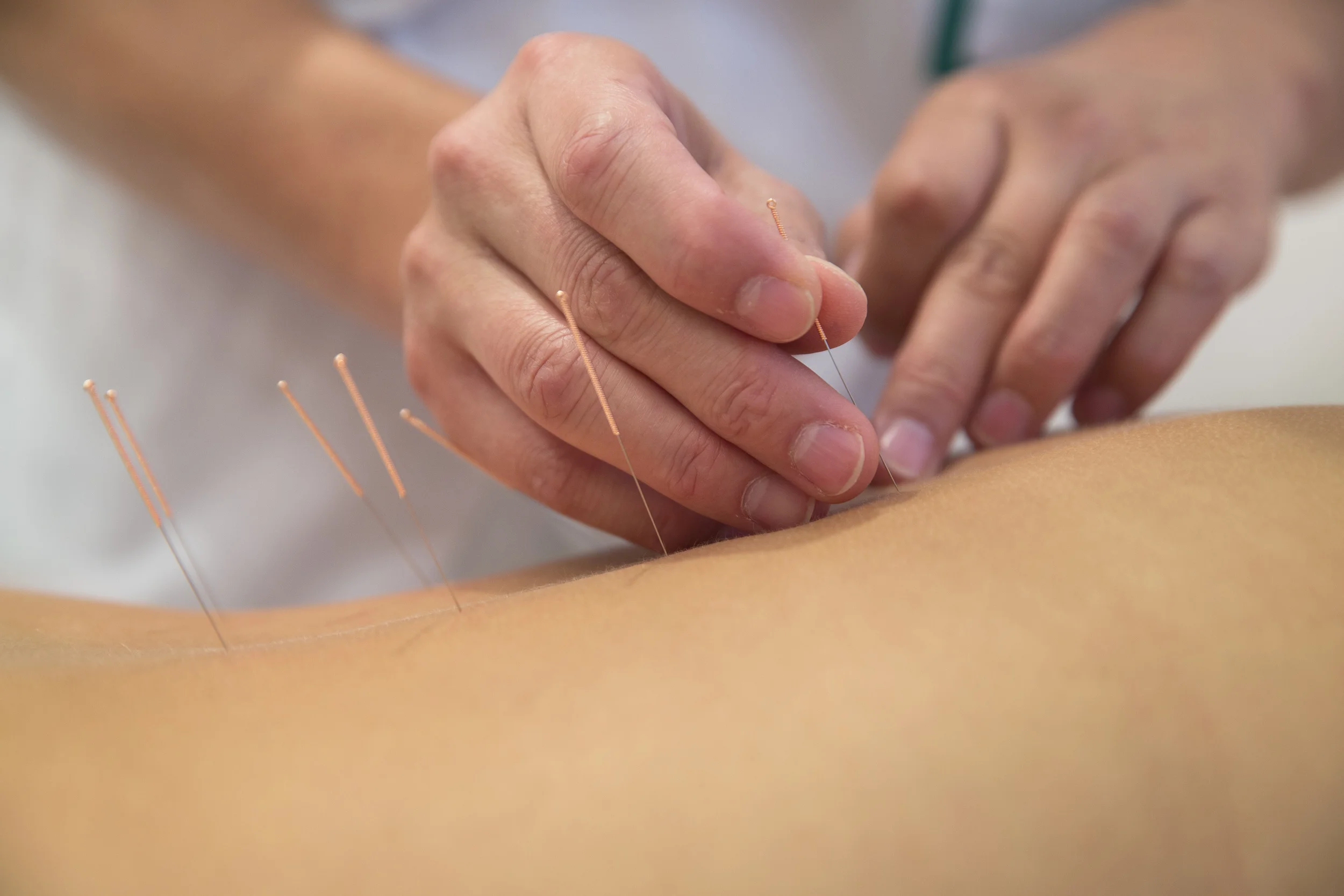 acupunctuur
