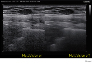 MultiVision By compounding many scan lines for better imaging, MultiVision provides remarkable spatial and contrast resolution with even greater artifact suppression than ever before.