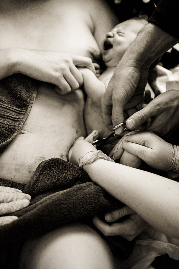 Photo of crying newborn as its umbilical cord is cut