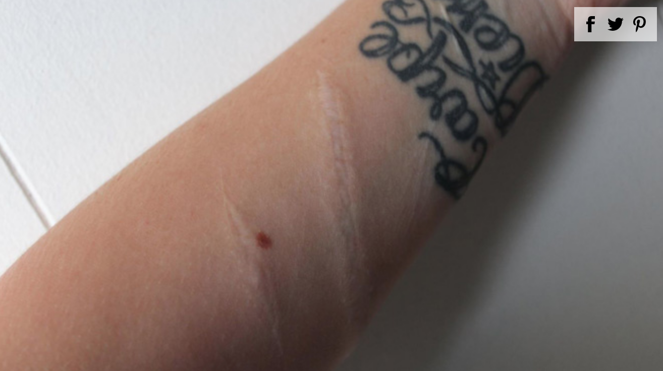 Woman Bravely Posts Scars From Failed Suicide Attempt as Warning for Teens