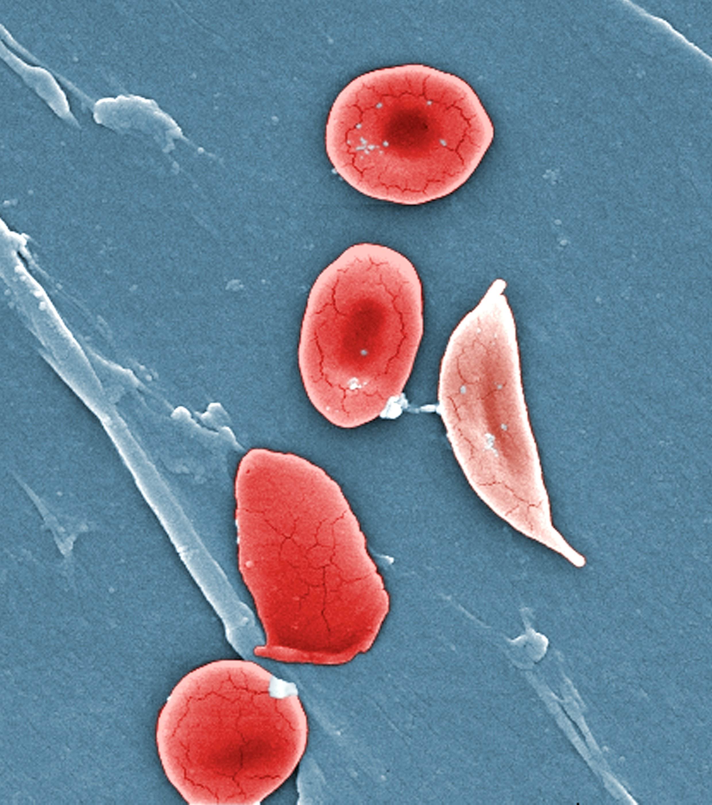 comparative-ultrastructural-morphology-between-normal-red-blood-cells-rbcs-and-a-sickle-cell-rbc.jpg