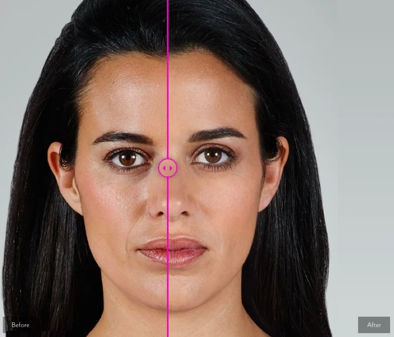 before and after Juvéderm Vollure XC wrinkle treatments at siti med spa in san diego