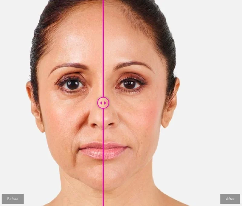 Best Filler for Laugh Lines Nasolabial Folds + Lines